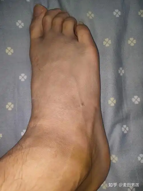 右踝关节扭伤崴脚恢复记录