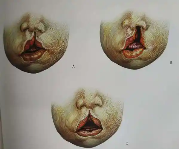 唇腭裂的发生及预防