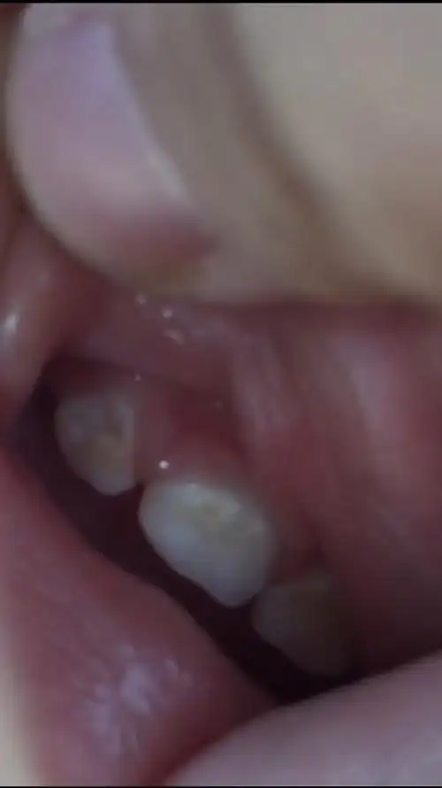 您好宝宝一岁上门牙出现黄斑中间黄斑两边出现牙釉质脱落的洞