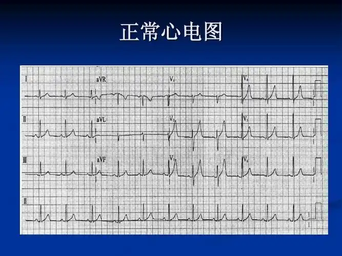正常心电图