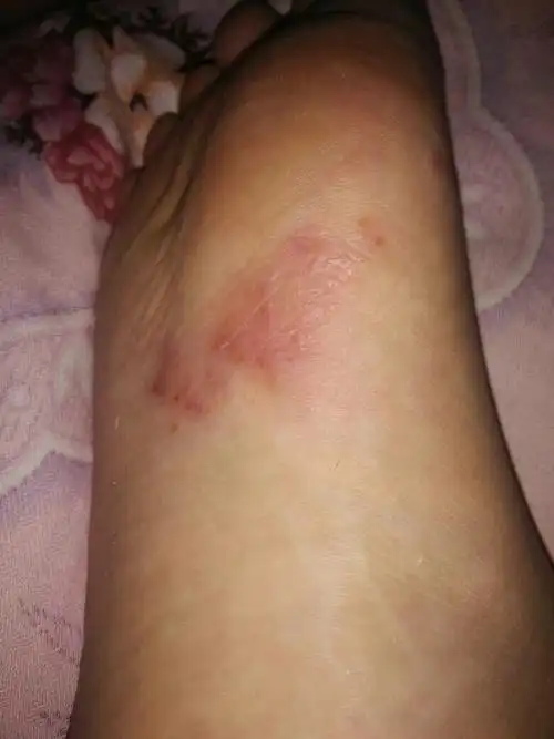 脚底长了很多红红的东西