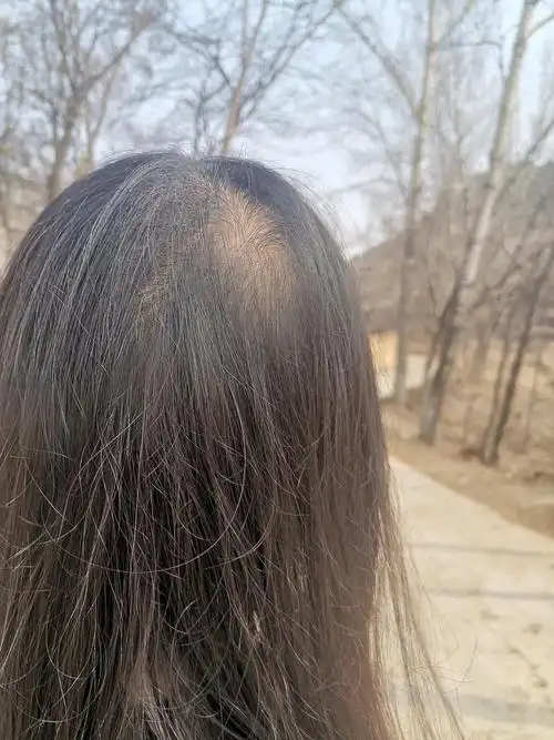 我的头发天生细软塌,高三压力大,脱了很多,头顶稀疏.