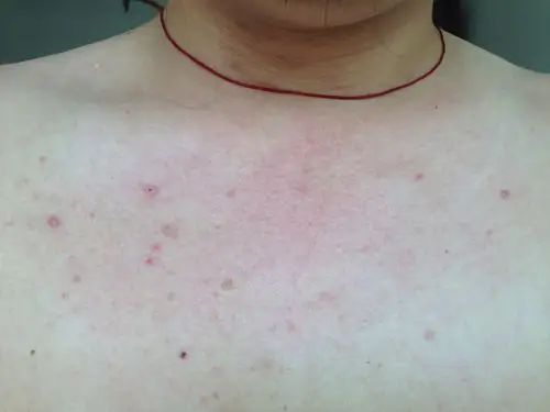 请在线皮肤病专家为我看看胸前长的皮疹· 好像是热的时候有些痒.