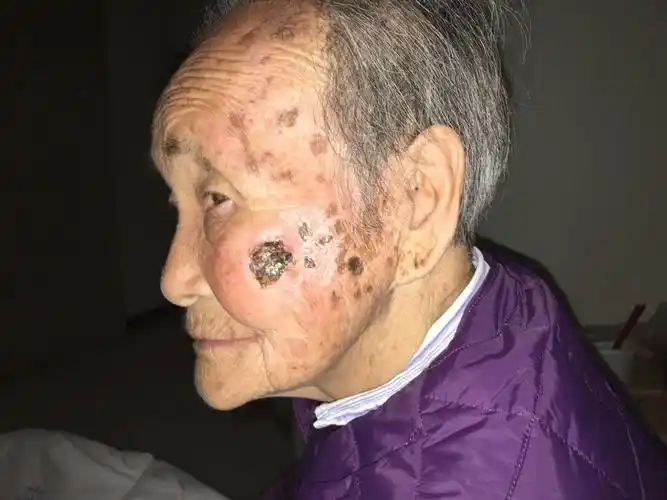 面部基底细胞癌