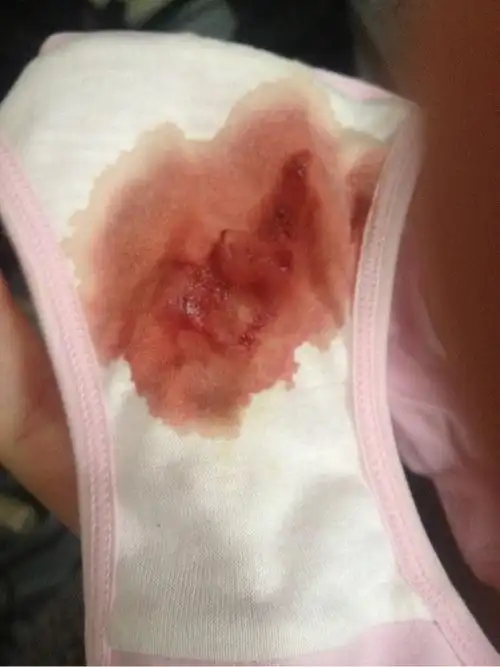 怀孕流白色流血块图片 - 搜狗图片搜索