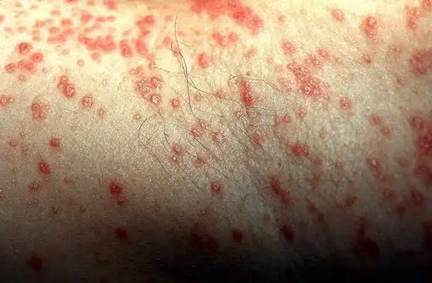 红色斑丘疹 (22)_有来医生