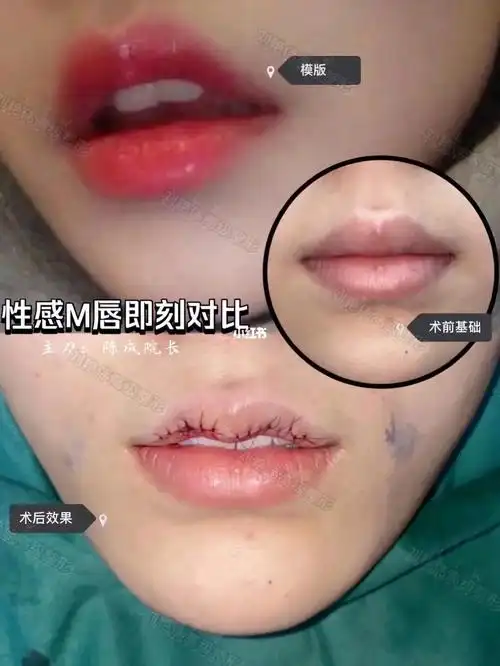 甜美自然的m唇 术后即刻90_美妆_医美_整容_美妆_医美整形