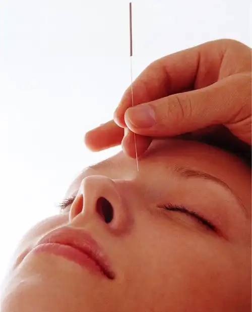 面瘫的针灸治疗