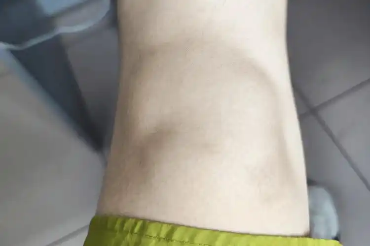 滑膜炎自愈经历:相信这些方法大家能用到!_膝盖_医生_时间