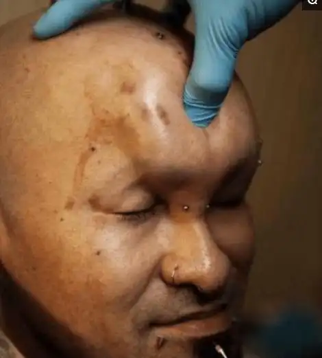 传说中真正的脑袋进水,日本人喜欢的整形方式,你敢尝试一下吗?