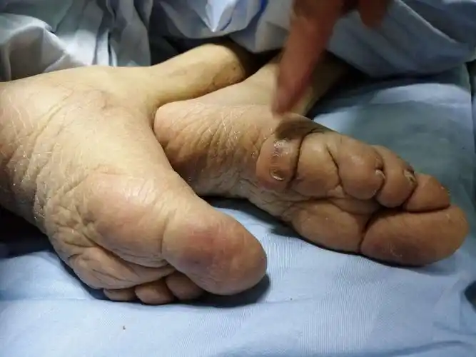 母亲的裹脚,用这双脚走过了85个春夏秋冬,尝尽了人间的酸甜苦辣.